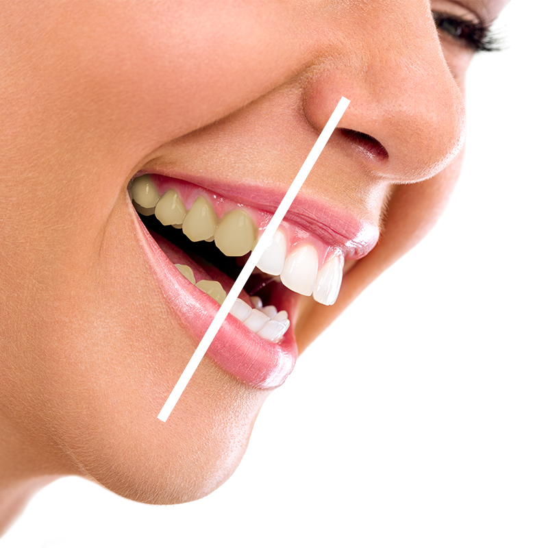 portadenti individuali per sbiancamento e muffe. imitazione di una dentiera  5327282 Stock Photo su Vecteezy